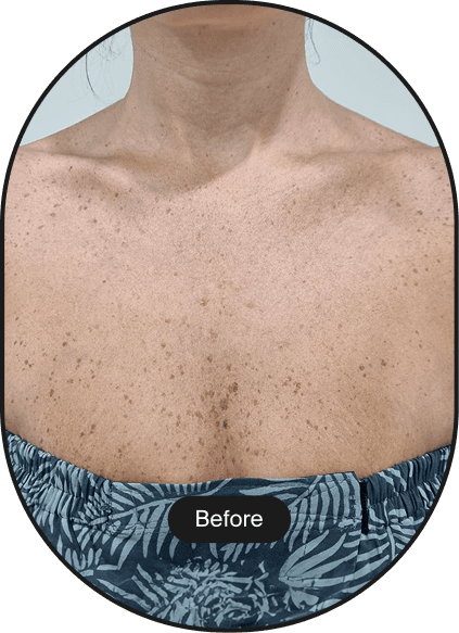 IPL Pigmentation Treatment