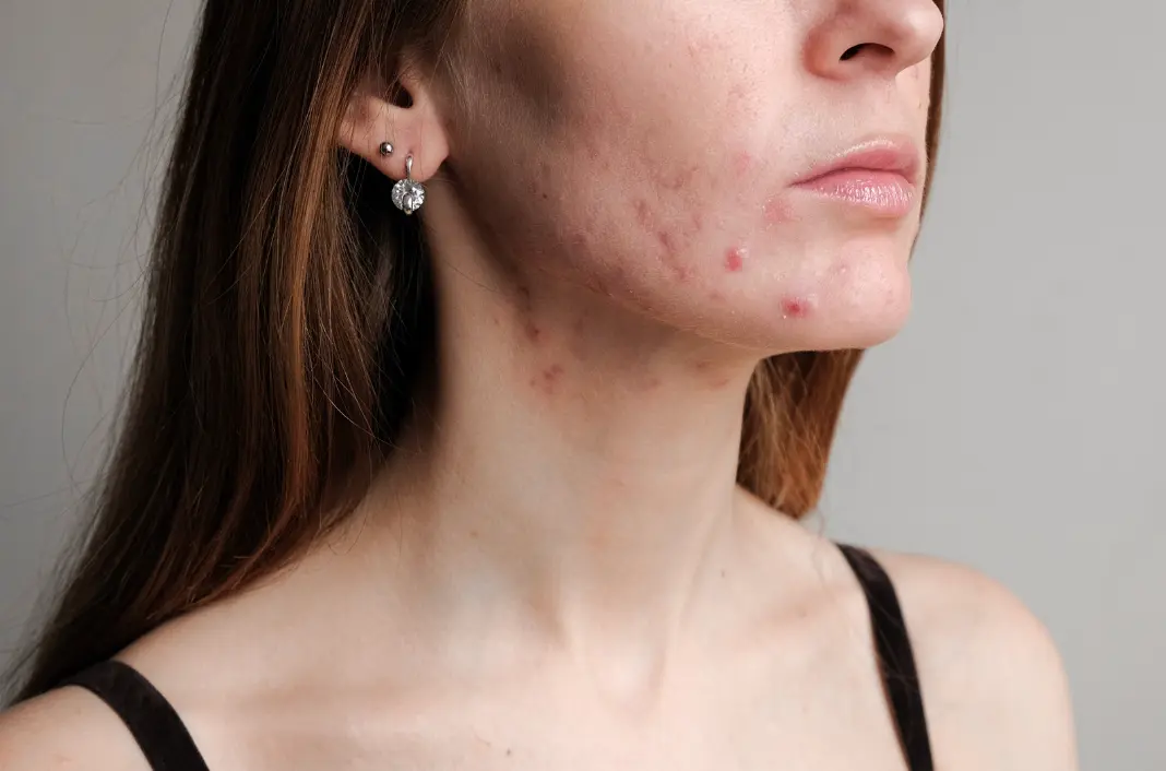What is Acne?