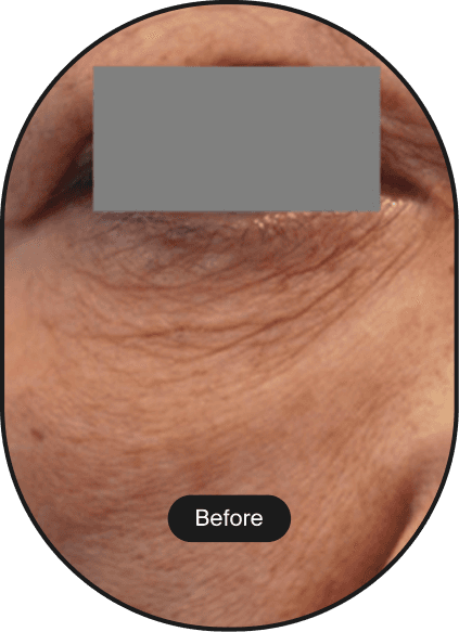 DDR Tip Lifting Treatment (Treatment Name)