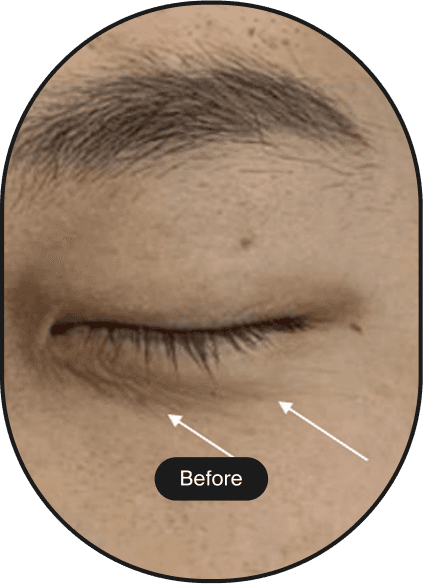 DDR Tip Lifting Treatment (Treatment Name)