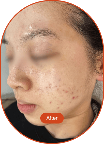 LINEAR-Z HIFU Treatment