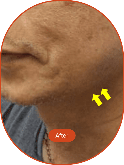 LINEAR-Z HIFU Treatment