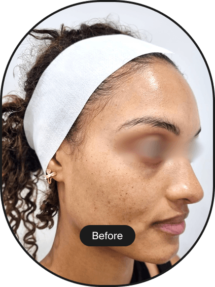 Tri-Beam Pigmentation Treatment