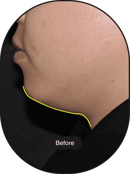 Ultracel Q+ HIFU