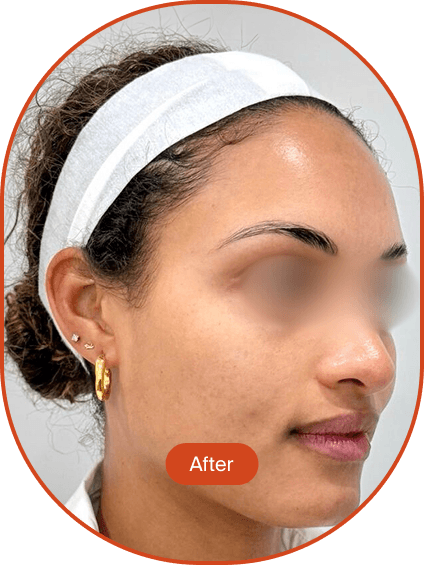 Tri-Beam Pigmentation Treatment