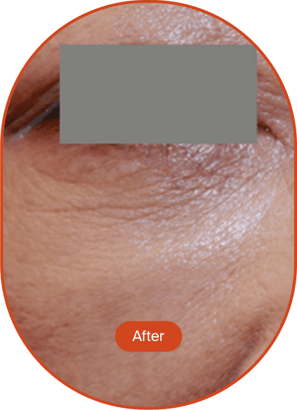 DDR Tip Lifting Treatment (Treatment Name)