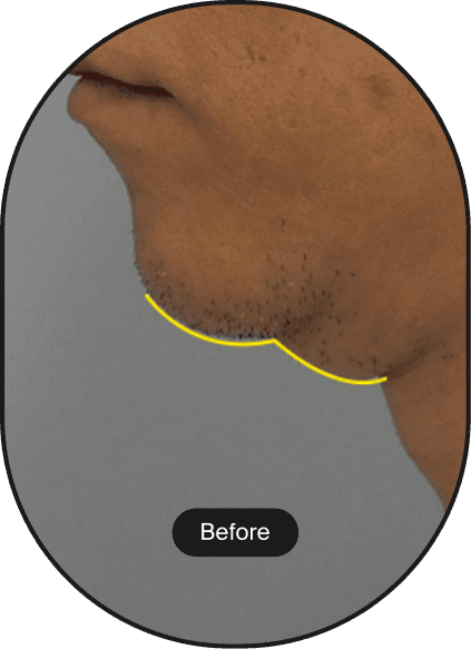 Ultracel Q+ HIFU