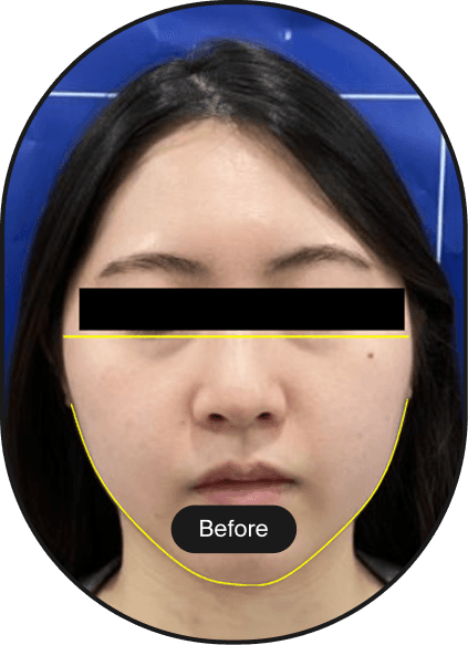 POTENZA DDR Tip Lifting Treatment 