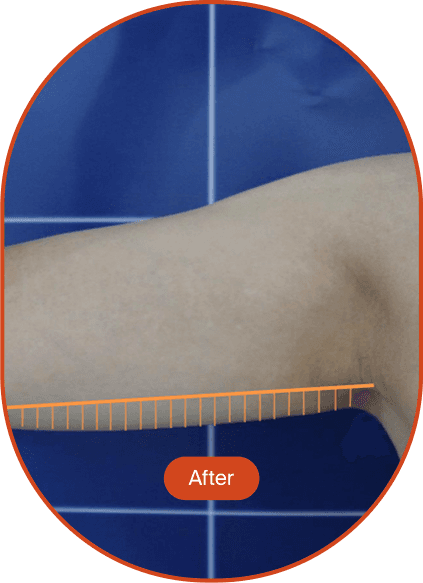 LINEAR-Z HIFU Treatment