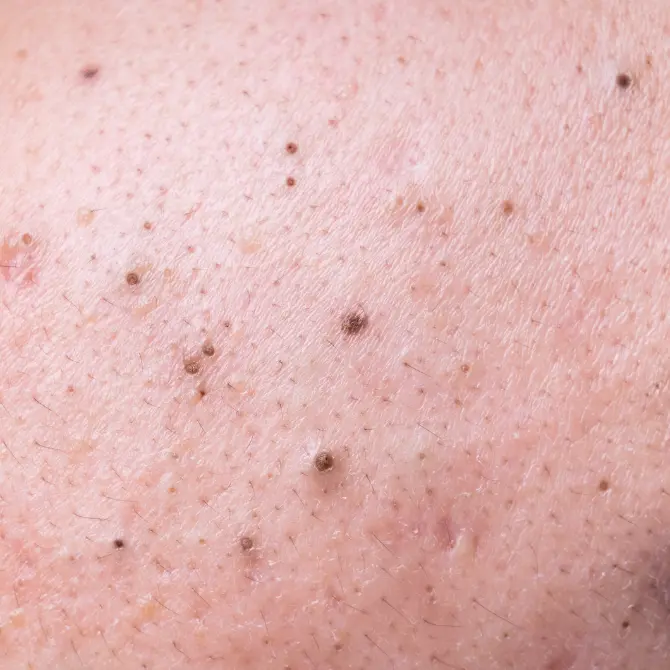 Concern Acne