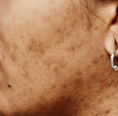 Concern Acne