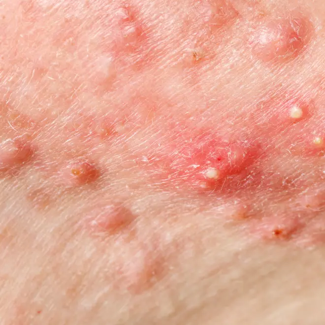 Concern Acne