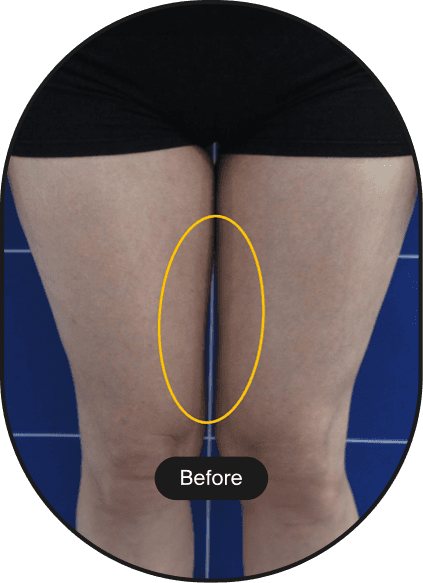 LINEAR-Z HIFU Treatment