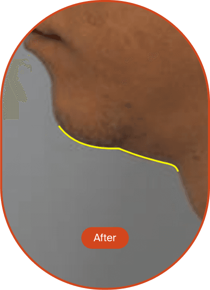 Ultracel Q+ HIFU