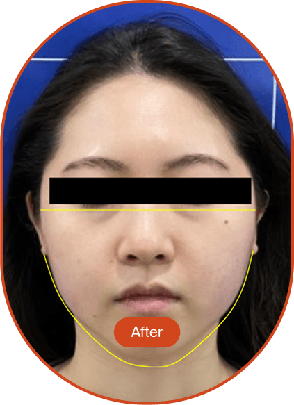 POTENZA DDR Tip Lifting Treatment 