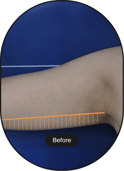 LINEAR-Z HIFU Treatment