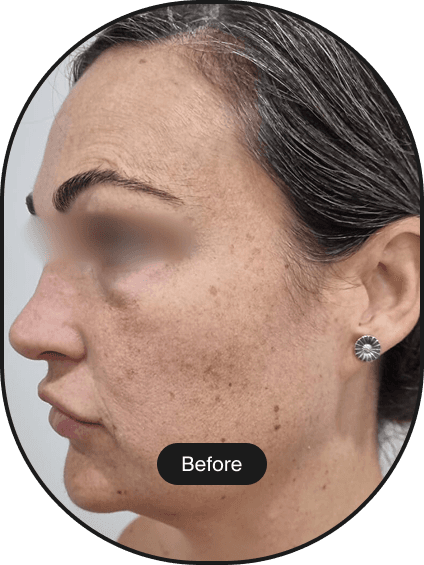 IPL Pigmentation Treatment