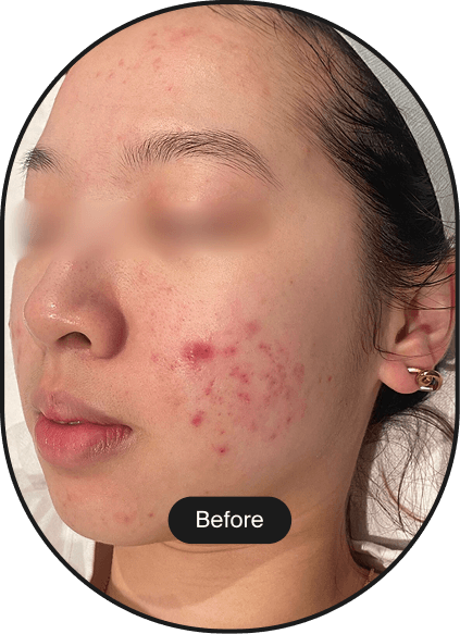 LINEAR-Z HIFU Treatment