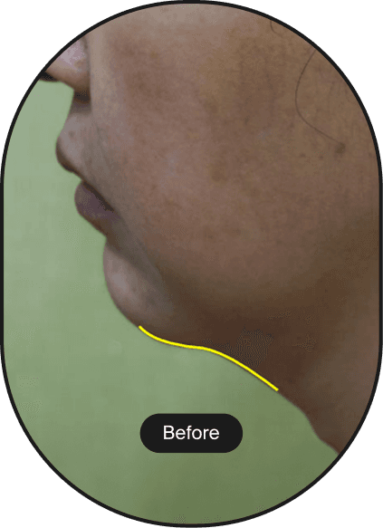 Ultracel Q+ HIFU