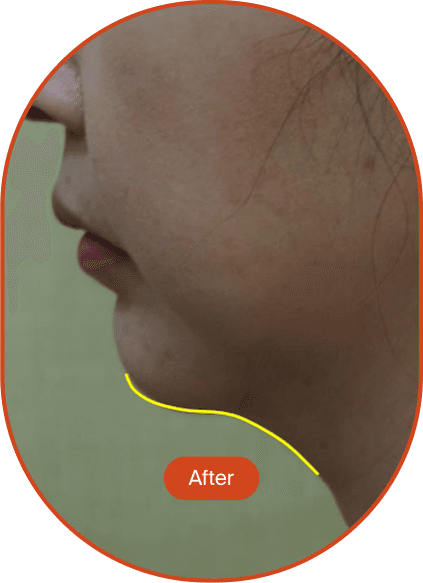Ultracel Q+ HIFU