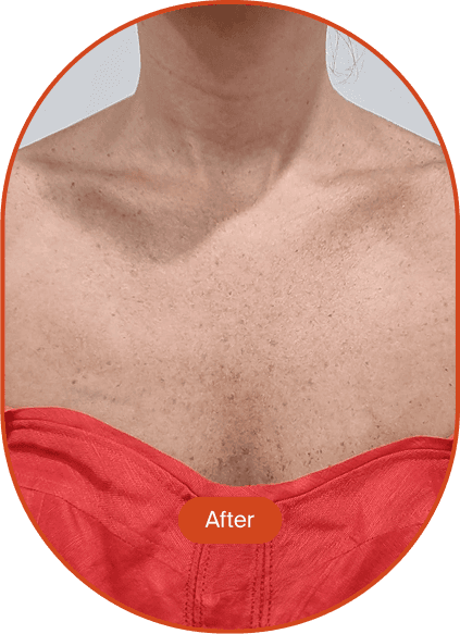 IPL Pigmentation Treatment
