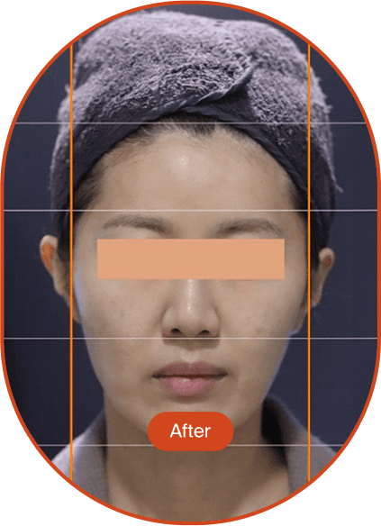 POTENZA DIA Tip, Sagging Treatment