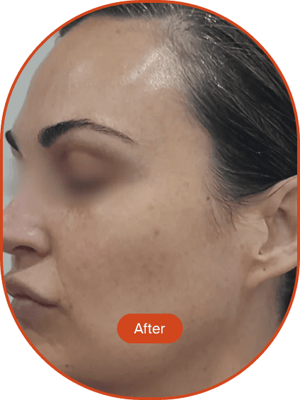 IPL Pigmentation Treatment