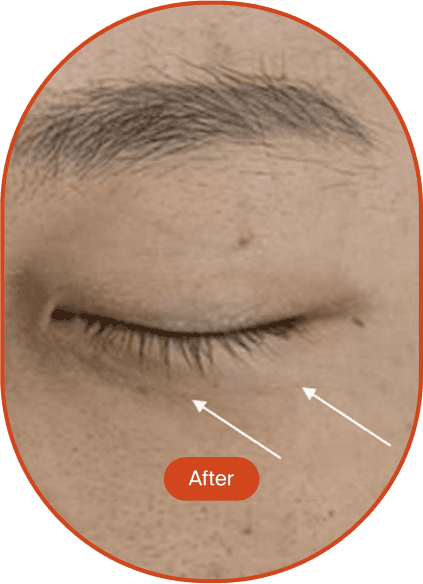 DDR Tip Lifting Treatment (Treatment Name)