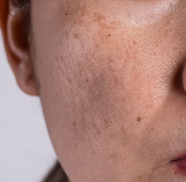 Concern Acne
