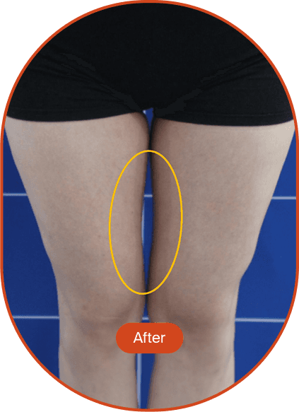 LINEAR-Z HIFU Treatment