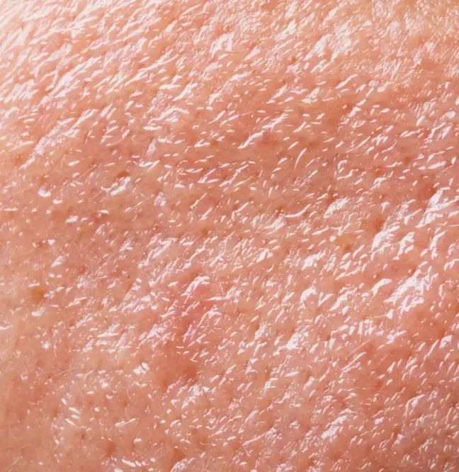 Concern Acne