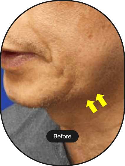 LINEAR-Z HIFU Treatment